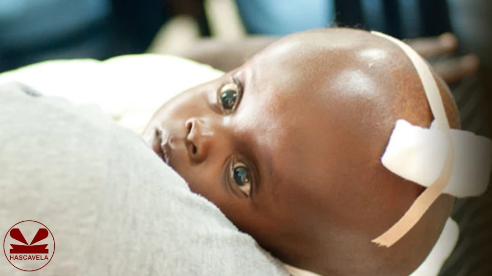 Kwenye picha kumeonesha mtoto mwenye tatizo la kichwa kikubwa akiwa amelala kitandani.